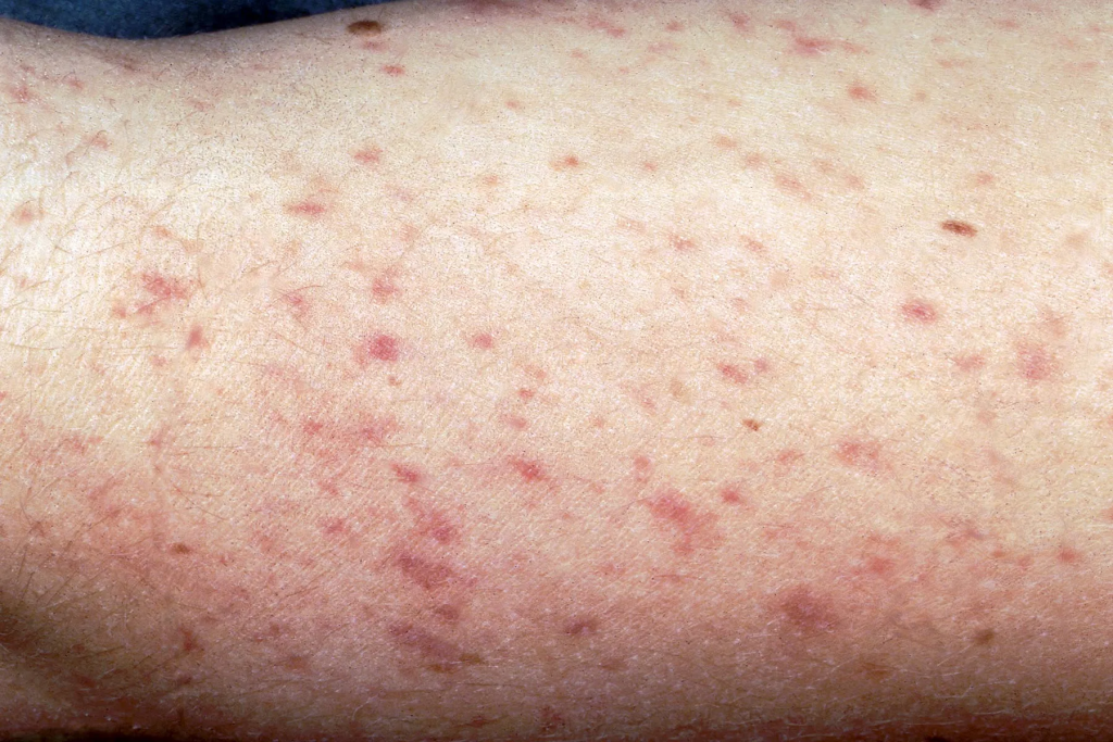 Meningitis erkennen und behandeln: Symptome, Prävention und wichtige Fakten für 2026